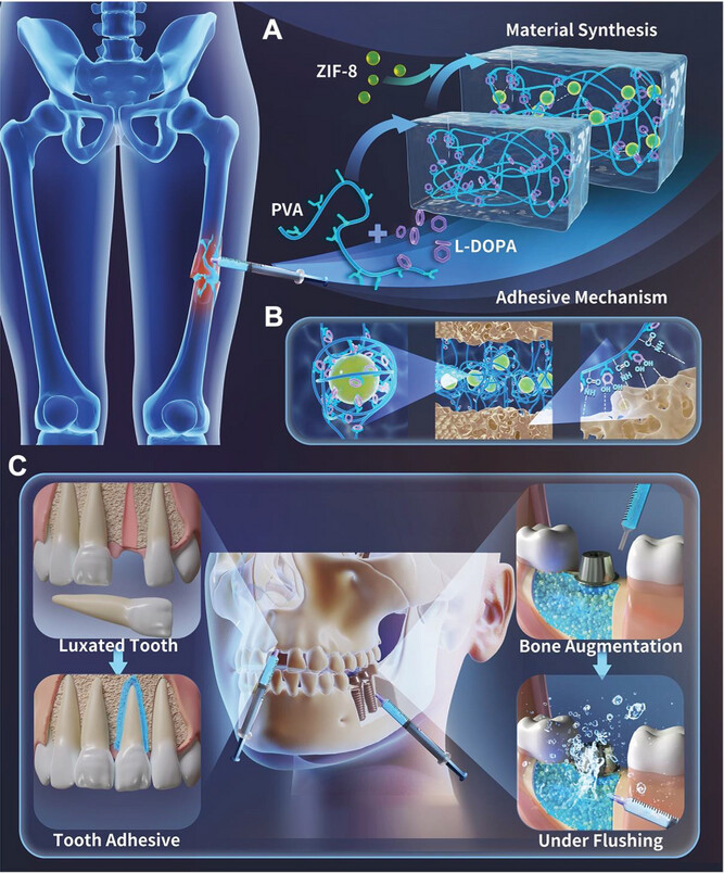 Goodbye to Screws and Plates: Scientists Unveil 3-Minute ‘Bone Glue’ That Heals Fractures Naturally 2 Diagram showing how Bone Glue bonds two bone fragments within 3 minutes